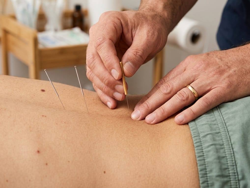 Dry Needling